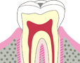 C1 エナメル質内の虫歯で象牙質までは達していないものです。