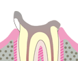 C4 虫歯で歯が殆どなくなってしまい、歯の根っこしか残っていない状態です。